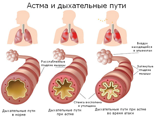 Бронхиальная астма симптомы