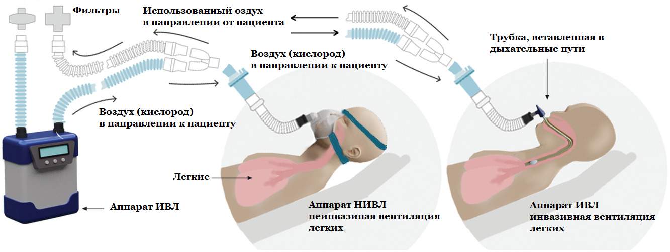 Мокрота лежачих больных. Аппарат неинвазивной искусственной вентиляции легких. Эндотрахеальная трубка для аппарата ИВЛ. Аппарат ИВЛ неинвазивной вентиляции.