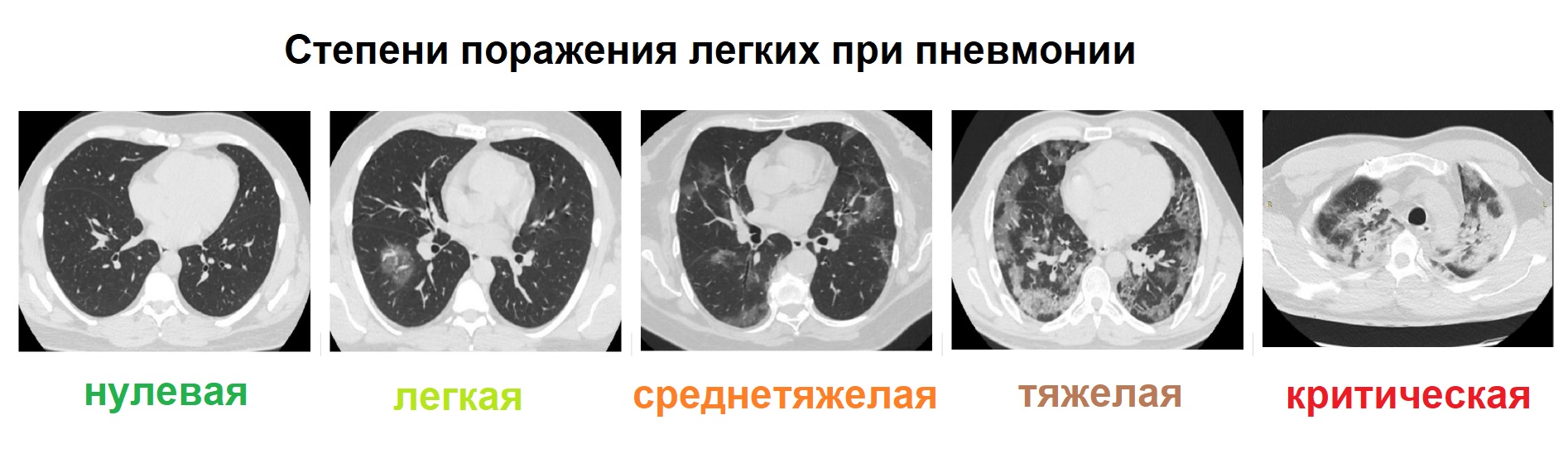 Поражение легких при ковиде. Стадии поражения легких. Поражение легких при коронавирусе. Степени поражения легких при коронавирусе по кт.