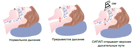 СИПАП терапия