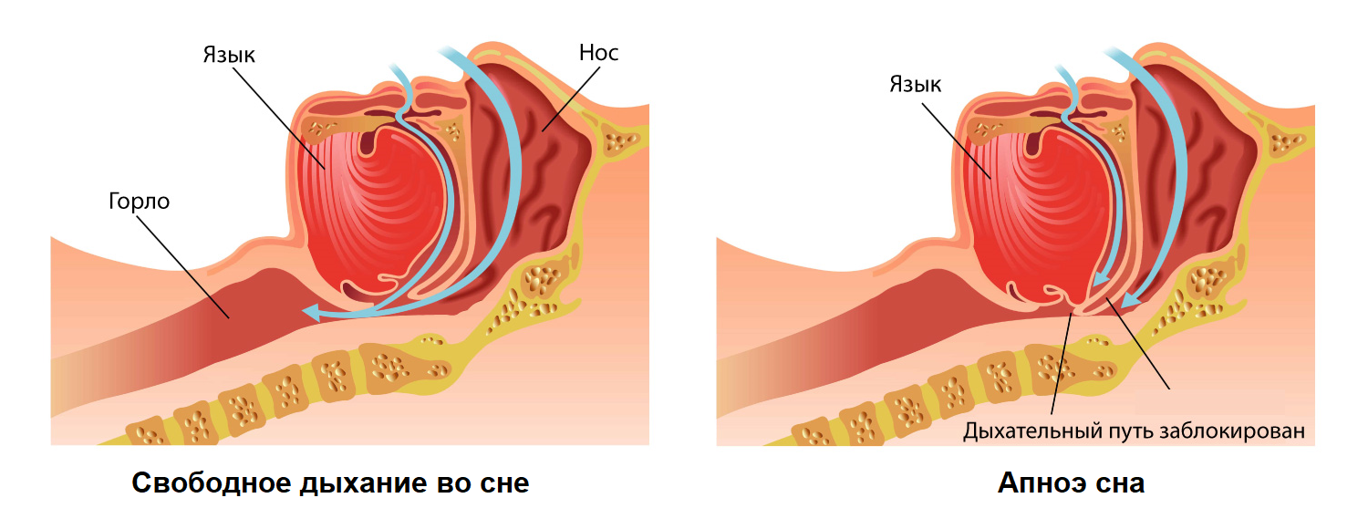 При засыпании останавливается дыхание. Синдром обструктивного апноэ сна патогенез.