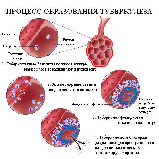 Образование туберкулеза легких